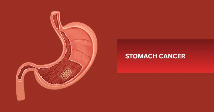 Dr. Ridham Shah providing advanced stomach cancer treatment Ahmedabad.
