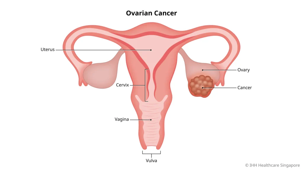 Dr. Ridham Shah | Best Ovarian Cancer Doctor in Ahmedabad providing expert diagnosis and advanced treatment