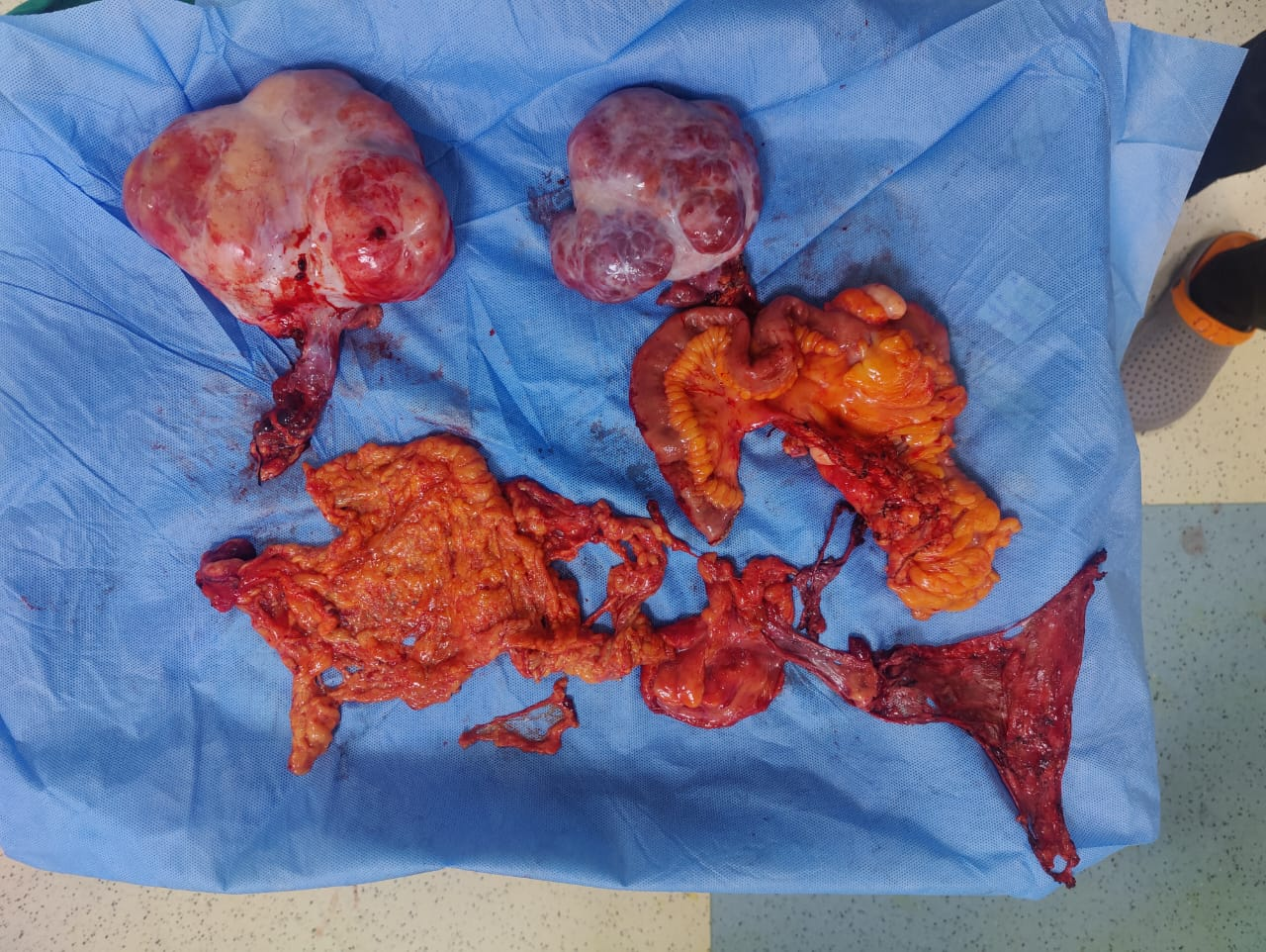 Ovarian cancer treatment in Ahmedabad by Dr. Ridham Shah